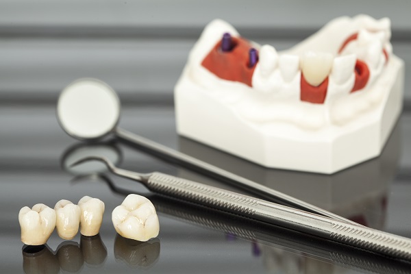The Steps Of A Dental Crown Restoration